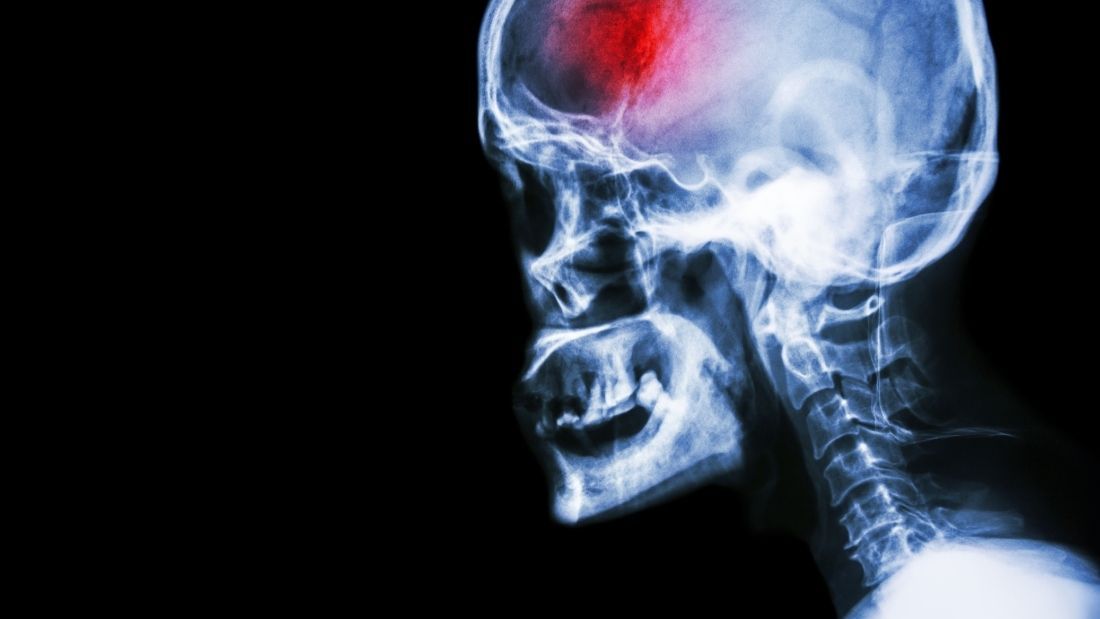 scan of brain after stroke