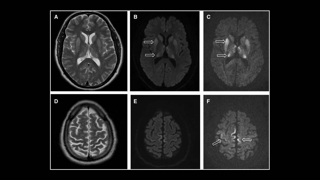 MRI of iCJD because of growth hormone