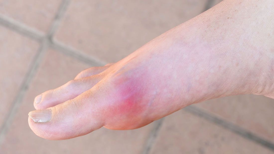 inflamed big toe joint